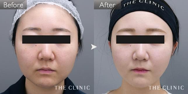 症例写真 / ベイザー脂肪吸引 術前・術後