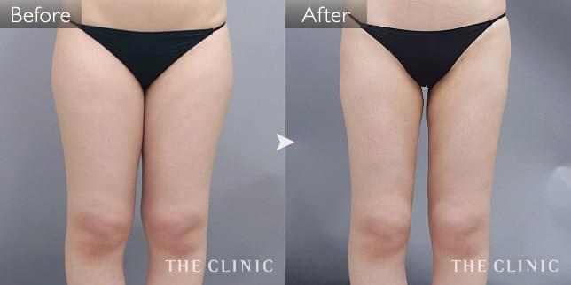 症例写真 / ベイザー脂肪吸引 術前・術後