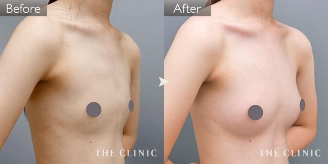 症例写真 / コンデンスリッチ豊胸 術前・術後