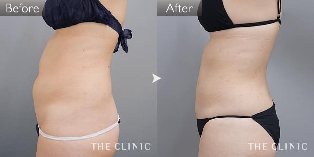 症例写真 / ベイザー脂肪吸引 術前・術後