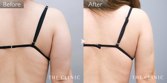 症例写真 / ベイザー脂肪吸引 術前・術後