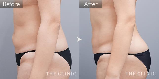 症例写真 / ベイザー脂肪吸引 術前・術後