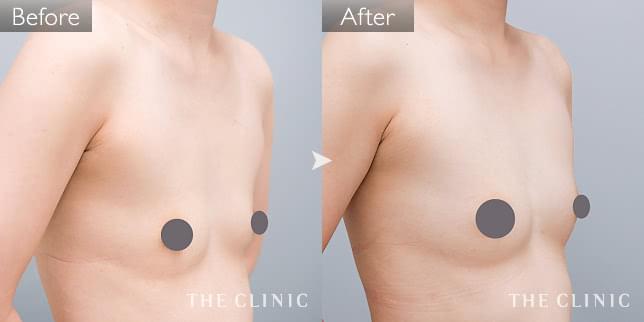 症例写真 / コンデンスリッチ豊胸 術前・術後