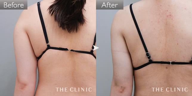 症例写真 / ベイザー脂肪吸引 術前・術後