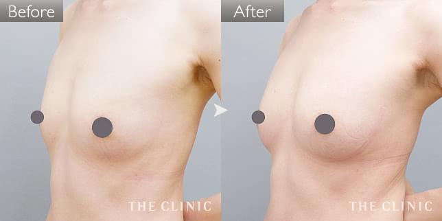 症例写真 / コンデンスリッチ豊胸 術前・術後