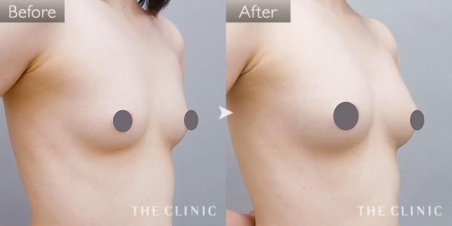 症例写真 / コンデンスリッチ豊胸 術前・術後