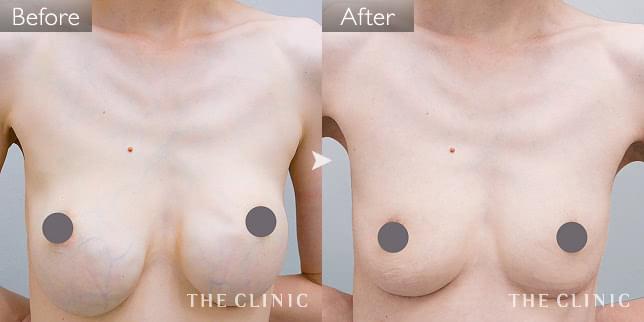 症例写真 / 豊胸シリコンバッグ除去 術前・術後