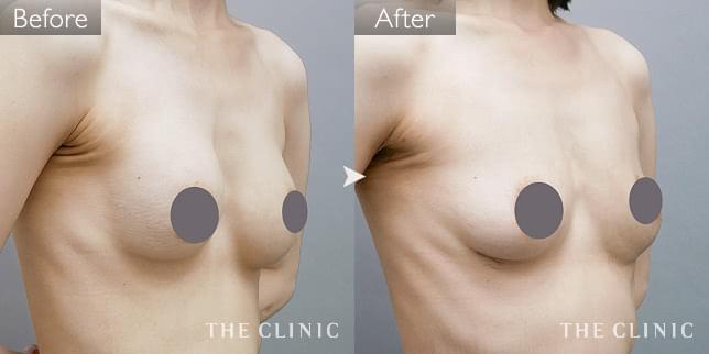 症例写真 / 豊胸シリコンバッグ除去 術前・術後