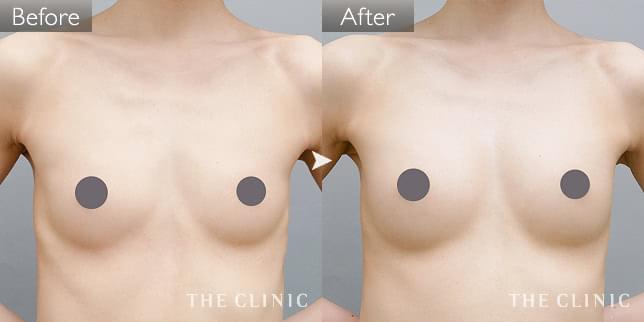 症例写真 / コンデンスリッチ豊胸 術前・術後