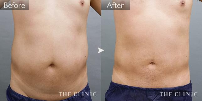 症例写真 / 360脂肪吸引® 術前・術後