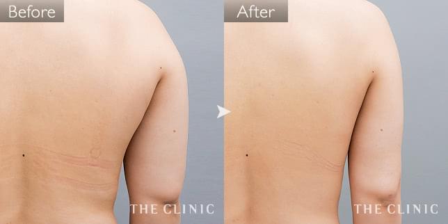 症例写真 / 360脂肪吸引® 術前・術後