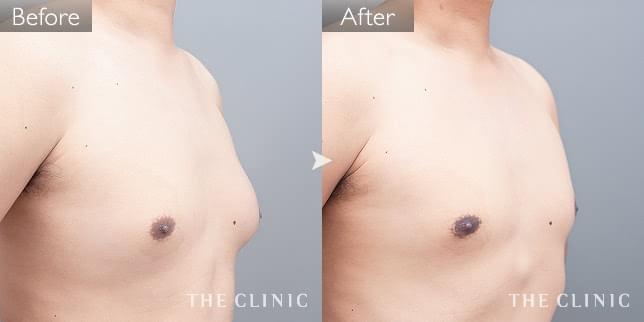 症例写真 / 女性化乳房治療(男性の胸の膨らみ改善) 術前・術後