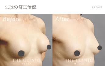 シリコンバッグ抜去／カプセル拘縮の他院豊胸バッグ抜去&コンデンスリッチ豊胸症例写真（女性／57歳）-術前/術後