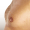 gynecomastia