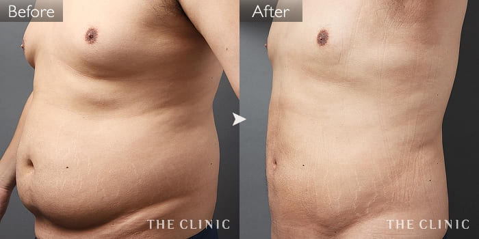 脂肪吸引 腹部 の症例写真 33歳 男性 ザクリニック大阪院 脂肪吸引 腹部 の症例写真 33歳 男性 ザクリニック大阪院