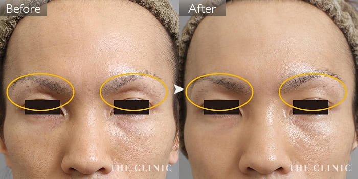 マイクロcrf注入 顔の脂肪注入 の症例写真 33歳 男性 ザクリニック大阪院