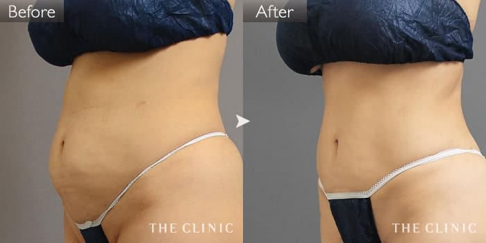 脂肪吸引 腹部 の症例写真 51歳 女性 ザクリニック大阪院 脂肪吸引 腹部 の症例写真 51歳 女性 ザクリニック大阪院