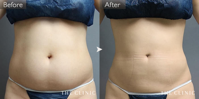 脂肪吸引 腹部 の症例写真 32歳 女性 ザクリニック大阪院
