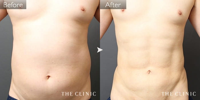 脂肪吸引 腹部 の症例写真 35歳 男性 ザクリニック大阪院