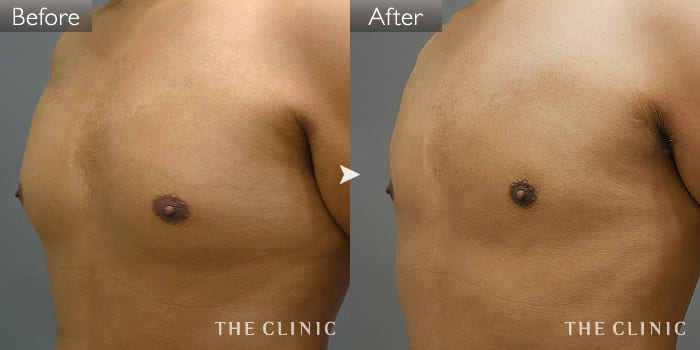 脂肪吸引 胸部のデザイン の症例写真 27歳 男性 ザクリニック大阪院