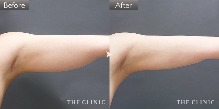 脂肪吸引 腹部 の症例写真 32歳 女性 ザクリニック大阪院