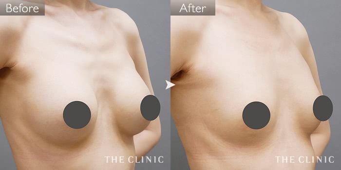 豊胸 豊胸シリコンバッグ除去 の症例写真 37歳 女性 大阪院
