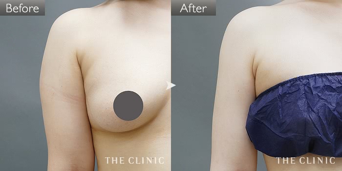 脂肪吸引 背中 の症例写真 46歳 女性 ザクリニック大阪院 脂肪吸引 背中 の症例写真 46歳 女性 ザクリニック大阪院