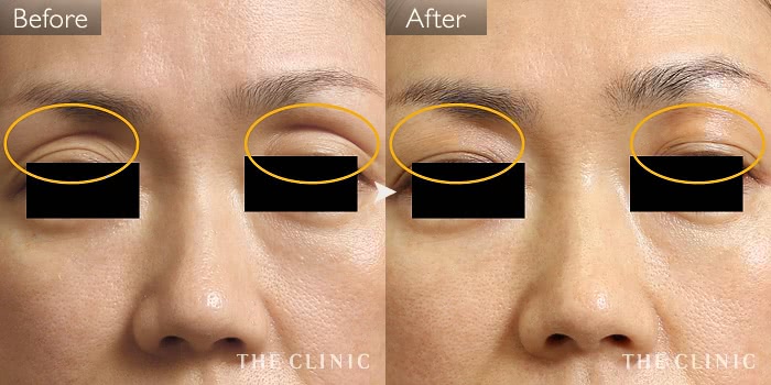 マイクロcrf注入 顔の脂肪注入 の症例写真 45歳 女性 ザクリニック大阪院