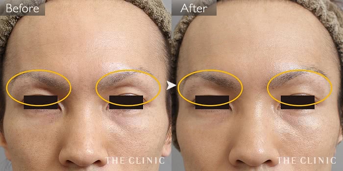 マイクロcrf注入 顔の脂肪注入 の症例写真 53歳 男性 ザクリニック大阪院