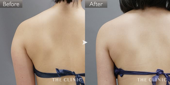 脂肪吸引 背中 の症例写真 46歳 女性 ザクリニック大阪院 脂肪吸引 背中 の症例写真 46歳 女性 ザクリニック大阪院