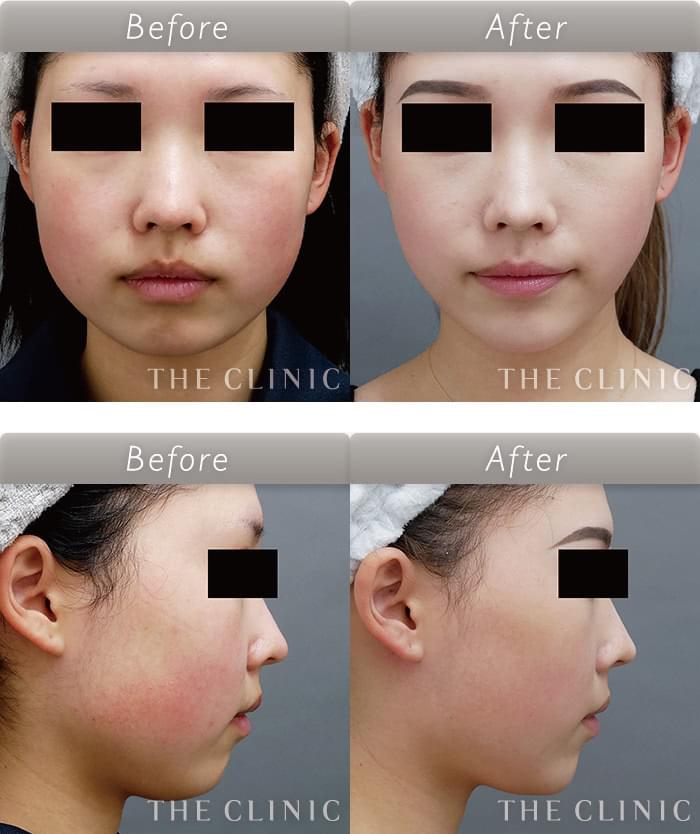 顔の脂肪溶解注射 小顔注射 とは 特徴 効果 失敗例 The Clinic 大阪院 顔の脂肪溶解注射 小顔注射 とは 特徴 効果 失敗例 The Clinic 大阪院