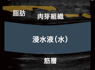 大阪で脂肪吸引ならザクリニック 費用 リスク 術後経過 Q A 大阪で脂肪吸引ならザクリニック 費用 リスク 術後経過 Q A